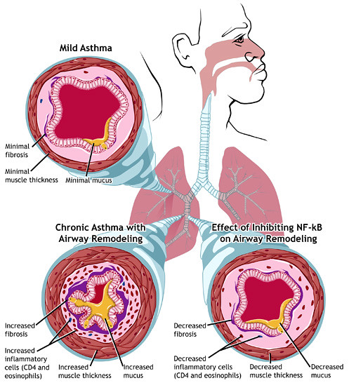 A person experiencing respiratory distress and using an inhaler, indicative of an asthma exacerbation. This image underscores the potential worsening of asthma symptoms in the presence of mold in indoor environments